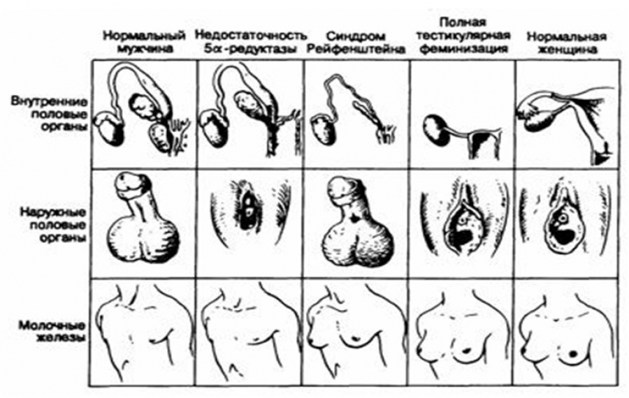 СИНДРОМ ТЕСТИКУЛЯРНОЙ ФЕМИНИЗАЦИИ  (ЛОЖНЫЙ МУЖСКОЙ ГЕРМАФРОДИТИЗМ, СИНДРОМ МОРРИСА